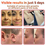 LBMLBM® MicroNeedle Botanic Skin Tag Removal Patch