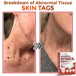 LBMLBM® MicroNeedle Botanic Skin Tag Removal Patch