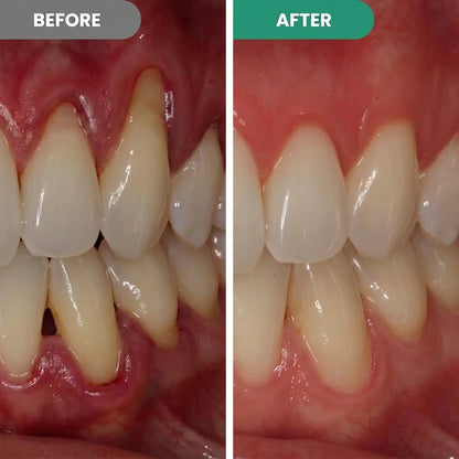 Teeth Repair Pen